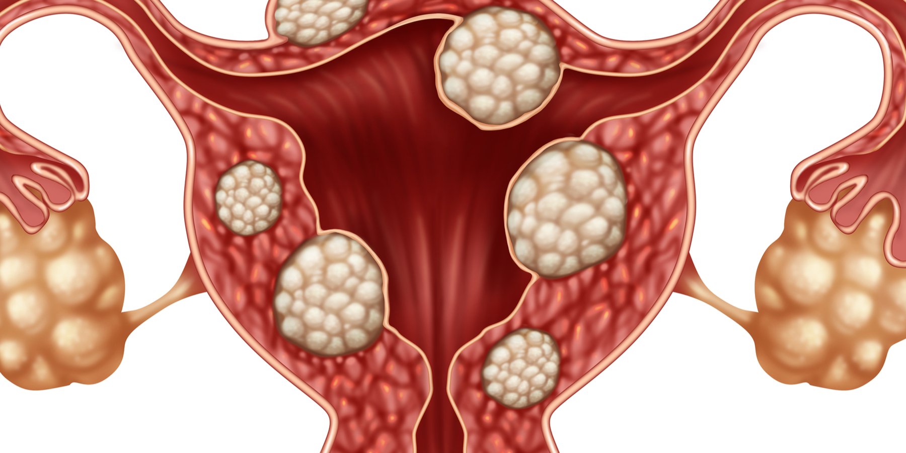 Treating Uterine Fibroids Journal Of Ethics American Medical Association 