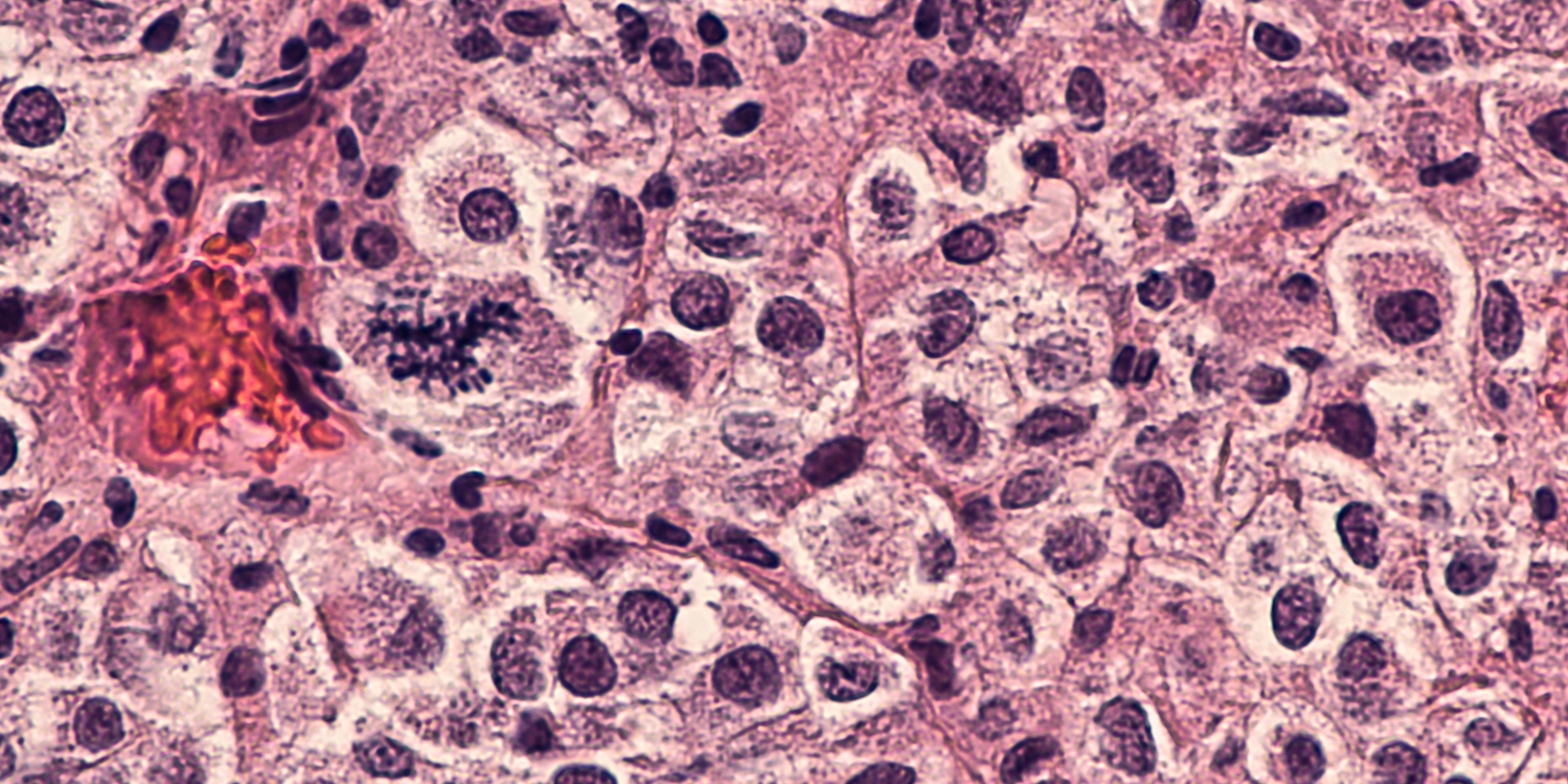 The ABCs of Melanoma Expanding Basic Screening and Education Journal