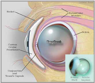 Illustration depicts a left post-evisceration eye socket in parasagittal section.