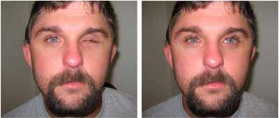 Left: a monocular patient with an empty socket. Right: the patient wearing a prosthesis.