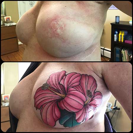 Unilateral Hibiscus Flower Mastectomy Tattoo on Reconstructed Chest
